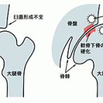 よくある病気：変形性股関節症 | Daisyu Orthopaedic Clinic