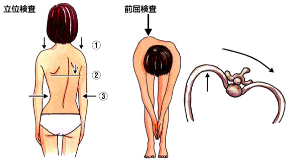 立位検査と前屈検査：日本側弯症学会編集、側弯のしおり『知っておきたい脊柱側弯症』より引用